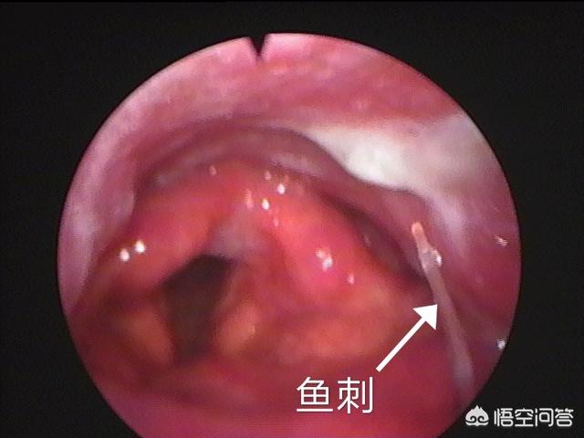 鱼刺卡喉咙了怎么办？