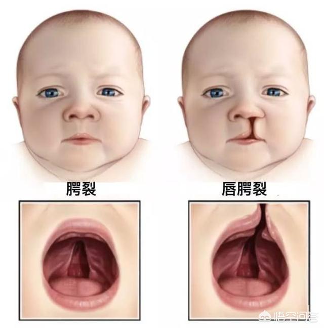 生兔唇宝宝是什么原因，什么原因导致宝宝出生是兔唇