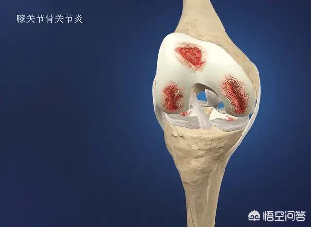 运动过量膝盖痛怎么办,过量的运动会损害膝关节吗？