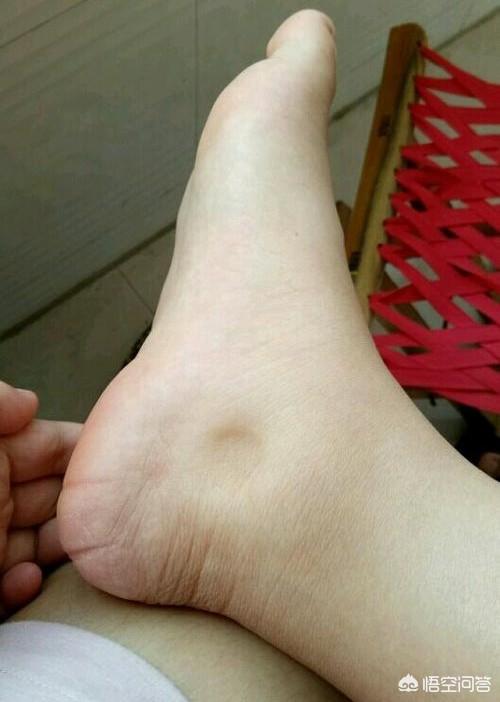 孕妇脚肿是什么原因:怀孕20周脚肿腿肿怎么办？