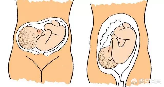 头条问答 - 怀孕超过30周,胎儿横位,脐带绕颈一周,该怎么办?