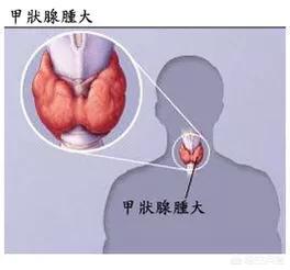 甲亢脖子，甲亢好了脖子会恢复如初吗