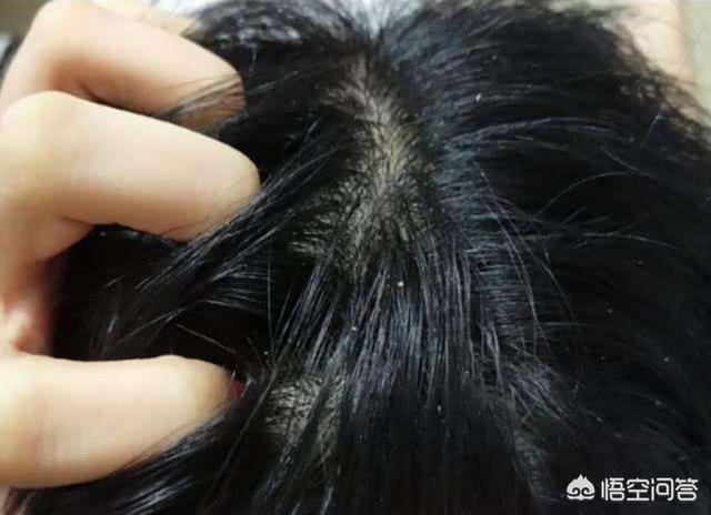 有哪些控油除螨比较好的洗发水推荐一下？