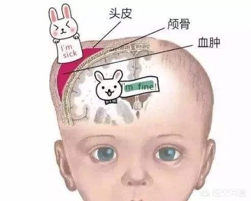 妈妈顺产后颈部有肿块:顺产头部水肿硬化了，还能恢复吗？