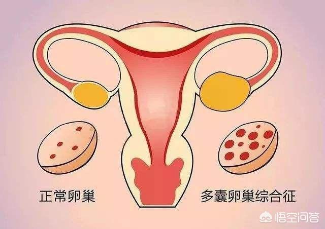 黑棘皮症后果严重吗:都说多囊会引起肥胖、月经推迟、长痘痘，还有什么其他症状吗？
