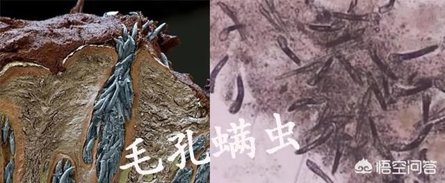 被螨虫咬了会螨虫感染吗:感觉全身上下都被螨虫“撕咬”，请问最快的除螨方法是什么？
