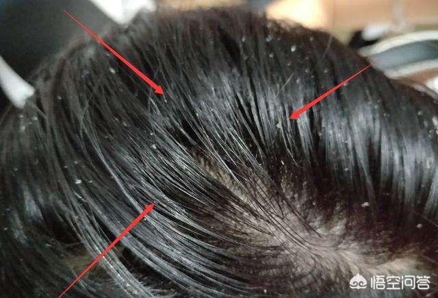 螨虫感染:头上感染螨虫后会怎么样？除螨有什么妙招？