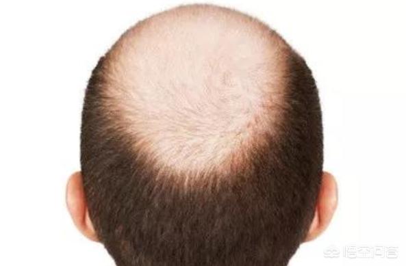 为什么有些五十岁的男人会秃顶,是肾虚吗？