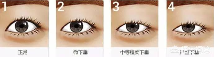 郑柔美整容前后:最早一批做双眼皮手术的人怎么样了？