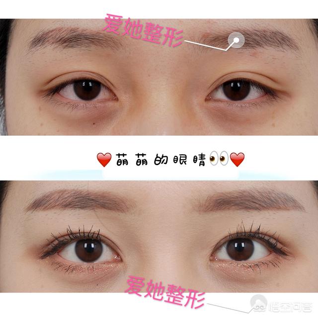 郑柔美整容前后:最早一批做双眼皮手术的人怎么样了？