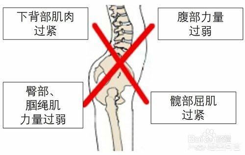 游泳可以改善骨盆前倾吗？