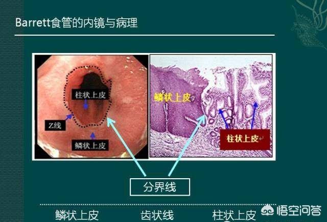 胃镜食管入口解剖图图片