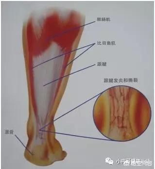 女生尾巴根疼是什么原因:男孩尾巴根疼是什么原因 引起足跟痛的原因是什么？