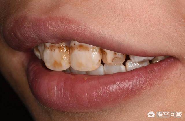 一口黄牙太影响气质如何让牙齿变白