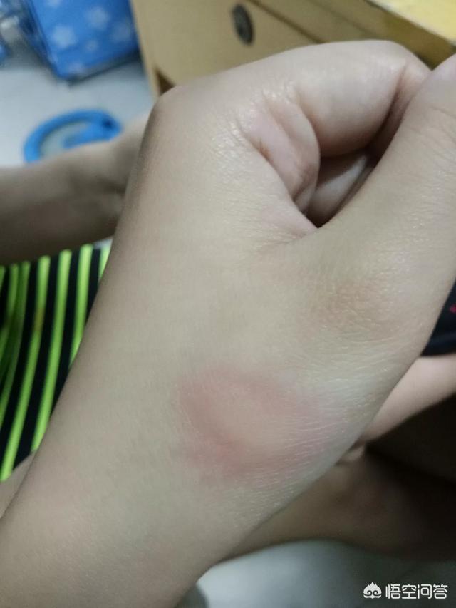 头条问答 - 为什么被蚊子叮咬后起个小包,人们喜欢用指甲打个十字呢?