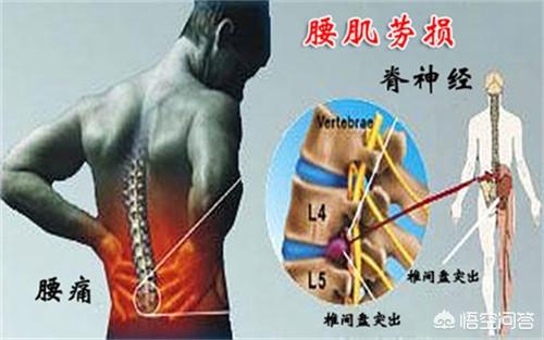 腰沐刻机椎间盘突出怎么治疗:腰椎舒缓器可以治疗椎间盘膨出吗 目前腰间盘突出手术成功率有多少？小手术效果如何？