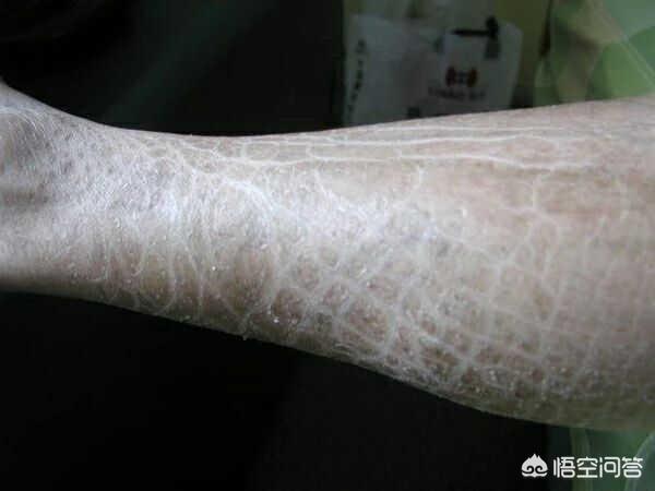 头条问答 鱼鳞病能根治吗 21个回答