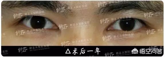 古巨基割双眼皮:对于男生割双眼皮你们怎么看