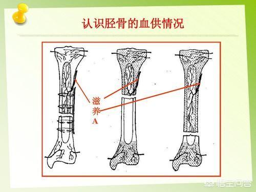 胫腓骨骨折长得慢怎么办:我右胫腓骨骨折四个月了，还没有愈合，是啥原因，怎么办？