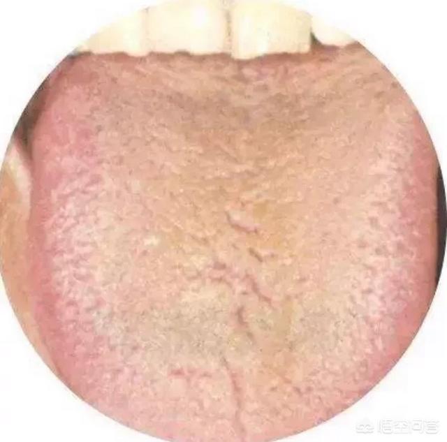 舌苔厚也是脾虚吗，经常牙齿发黄，口臭，舌苔厚，是什么原因？