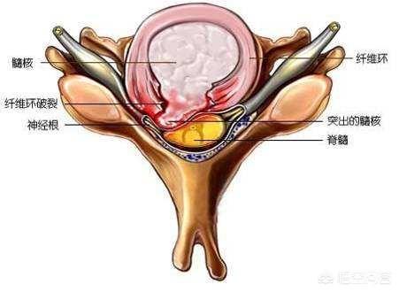 腰間盤膨出療法腰間盤膨出導致腿疼腿麻可以治癒嗎需要注意什麼