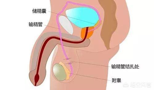 什么是男性绝育手术:老婆易受孕体质，男性结扎对身体有害吗？ 男性绝育手术有什么影响