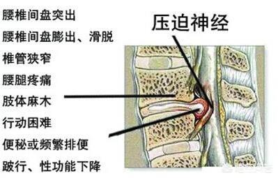 腰椎间盘突出压迫右腿图片