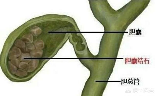 头条问答 - 怎样才能排出胆结石?(王镇说的回答,0赞)