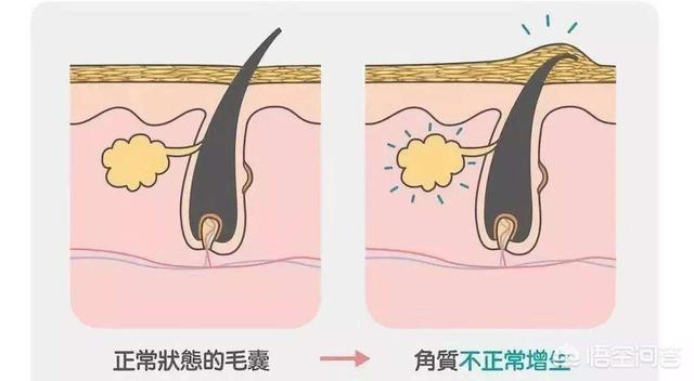 夏季皮肤问题图片:夏天如何改善“鸡皮肤”和“蛇皮肤”？