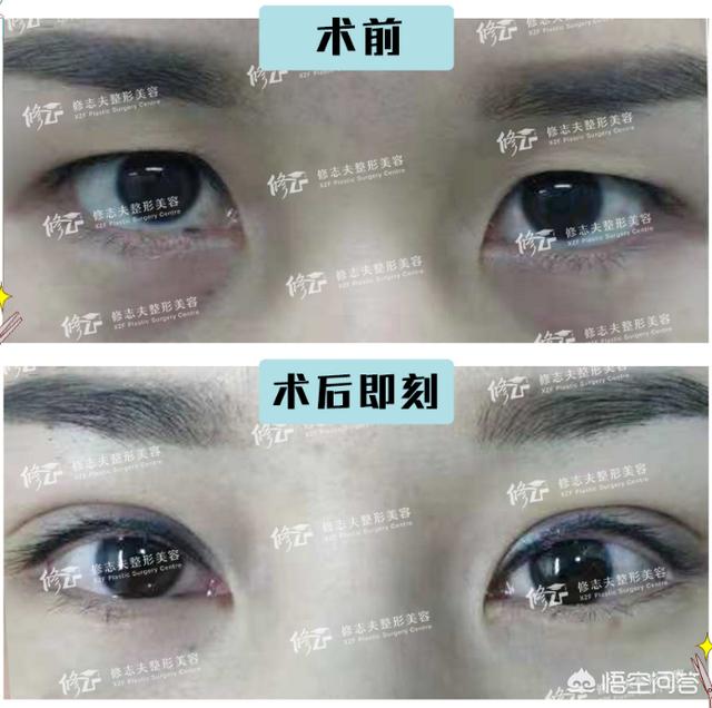 开眼角对比图:割双眼皮不开眼角是一种什么体验？