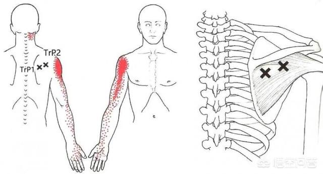 乳腺增生手臂酸痛是什么原因;右手臂酸痛是什么原因导致的