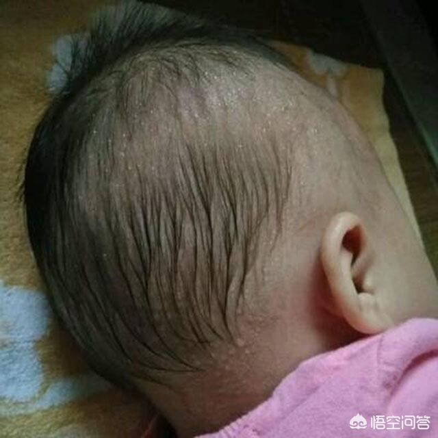 佝偻病的症状及图片:7个月宝宝需要补钙铁锌么？
