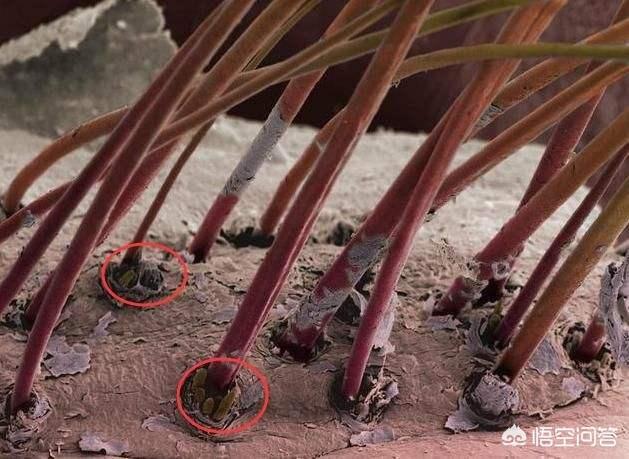 毛囊虫:脸上粉刺能挤出黄色颗粒是毛囊虫吗？