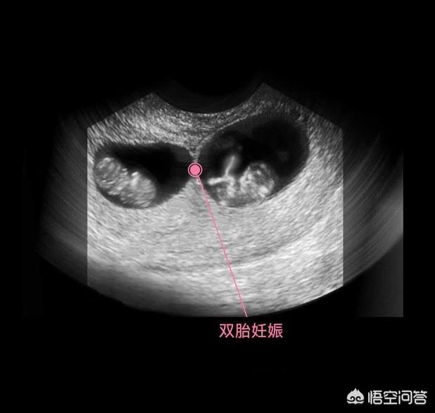 头条问答 一个孕囊两个胚芽,是双胞胎吗(37个回答)