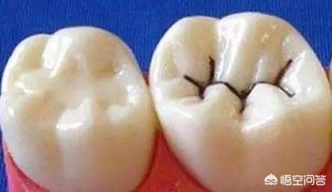 拜宠爽作用原理:你会给孩子做窝沟封闭吗？什么时候做比较合适？