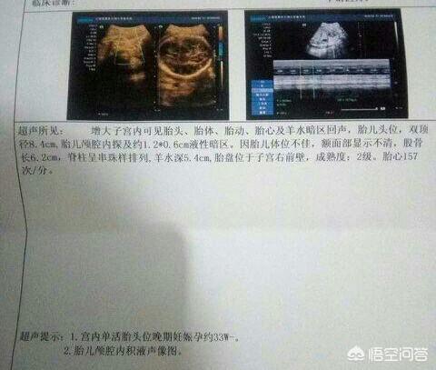 婴儿脑积水的症状:为什么一些宝宝刚生下来会有脑积水？