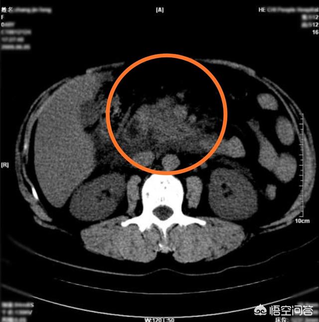 胰腺炎的症状及治疗:胰腺炎的症状及治疗一般要多久 胆囊结石引发急性胰腺炎，该怎么治疗？需要切除胆囊吗？