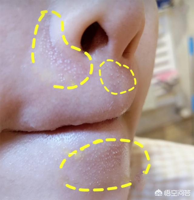 头条问答 脸上有一粒一粒的 小米粒 是怎么回事 家有爱女715的回答 0赞