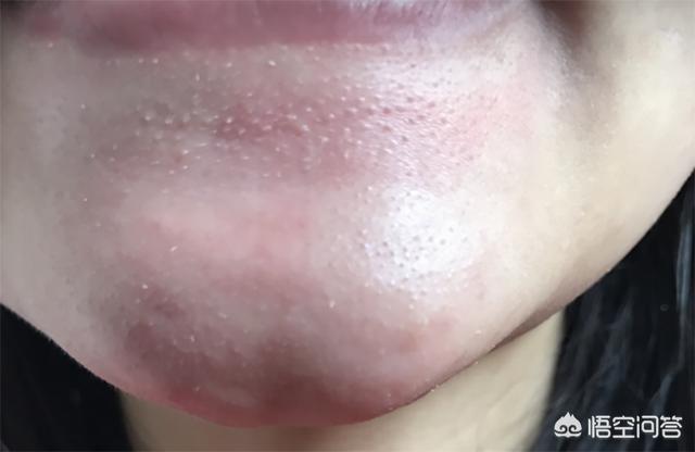 脂肪粒怎么去除脂肪粒怎么去除小窍门