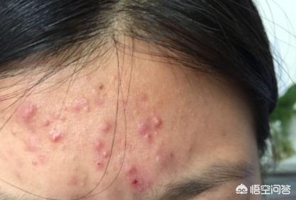 脸上有螨虫怎么治疗:如何有效祛除脸上的螨虫，让痘痘不再复发？