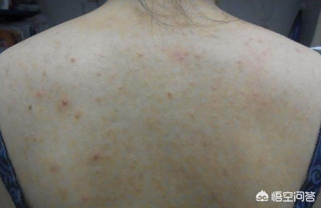 恙螨:螨虫是什么，会给人们带来那些危害，怎么防治？