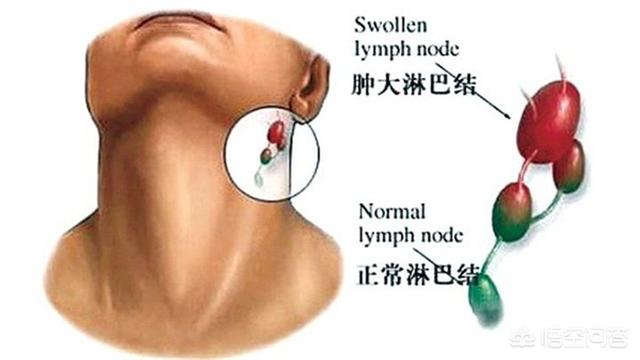 颈部淋巴结示意图图片