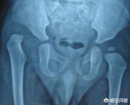 胯关节发育不良:宝宝髋关节发育不良，戴吊带矫正会对以后的走路姿势有影响吗？