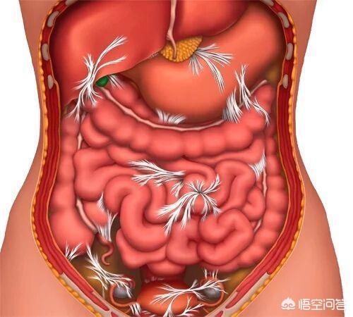 肠梗阻手术是大手术:小女孩肠梗阻需要手术吗？