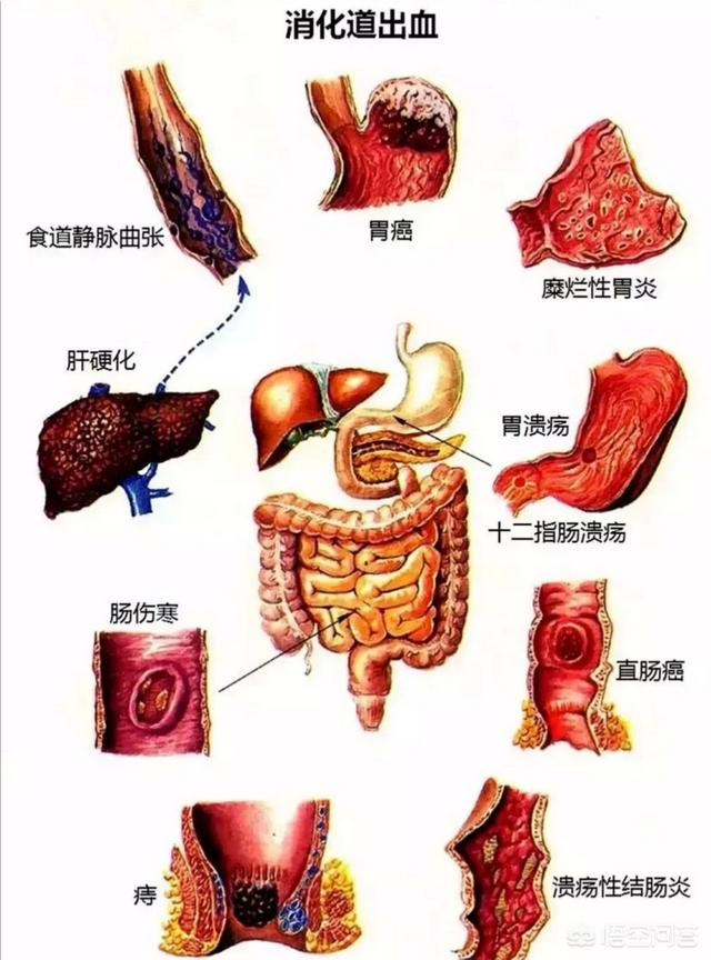 果酱样大便:刚才肚子疼，大便大酱色不成型是什么原因？