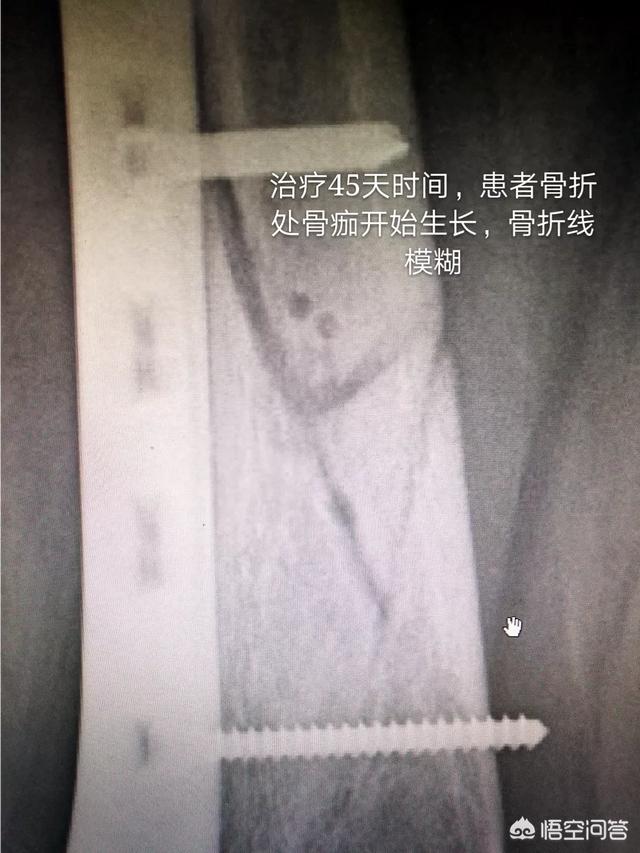 胫腓骨骨折长得慢怎么办:我右胫腓骨骨折四个月了，还没有愈合，是啥原因，怎么办？