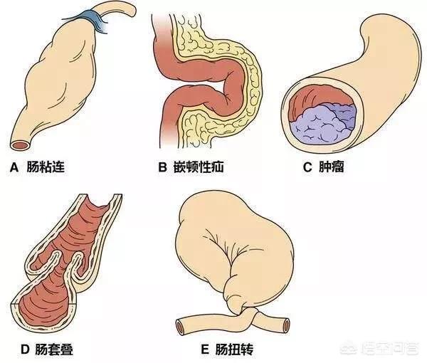 肠梗塞的治疗:八十多岁老人肠阻塞不治疗能活多久？
