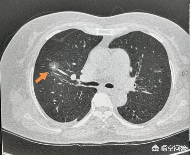 头皮黑色素瘤早期症状图片:黑色素瘤图片 早期症状图片 黑色素瘤有哪些早期症状？