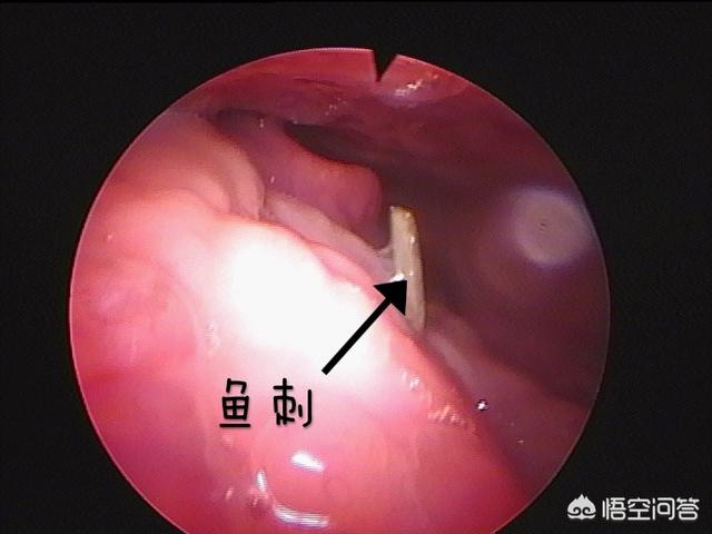 吞吃鱼:鱼刺卡住吞馒头真的管用吗？