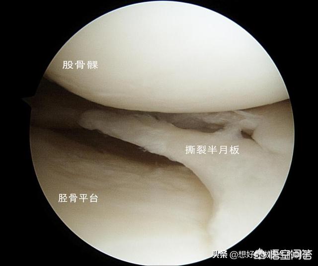 劳损性关节炎能治好吗:45岁得了骨关节炎，该怎样锻炼？ 劳损性关节炎能根治好吗